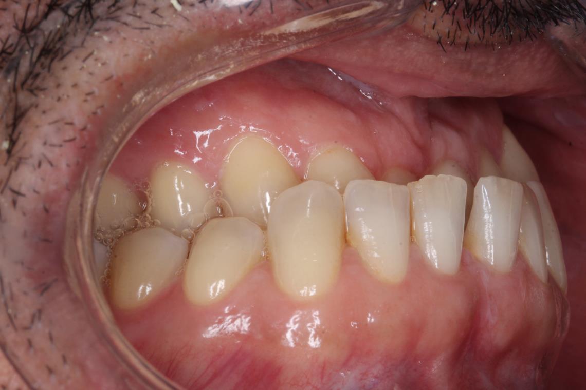 ADULTE CLASSE III TRAITEMENT ORTHODONTICO CHIRURGICAL 2