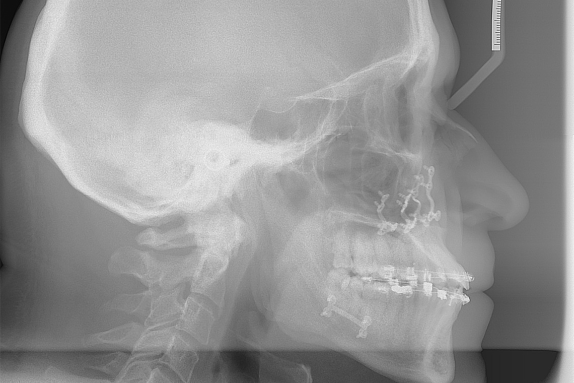 ADULTE CLASSE III TRAITEMENT ORTHODONTICO CHIRURGICAL 6