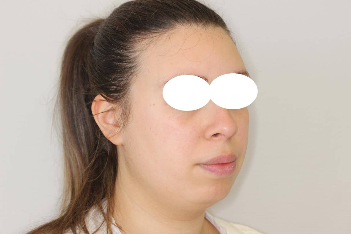 CLASSE I HYPER DIVERGENTE SQUELETTIQUE TRAITEMENT ORTHODONTIQUE ET CHIRURGIE BI MAXILLAIRE 7
