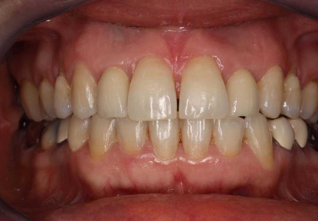 ORTHODONTIE AU SERVICE DE L IMPLANTOLOGIE 2